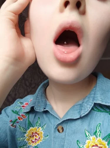 CuteBite™ Tongue Piercing Kit photo review